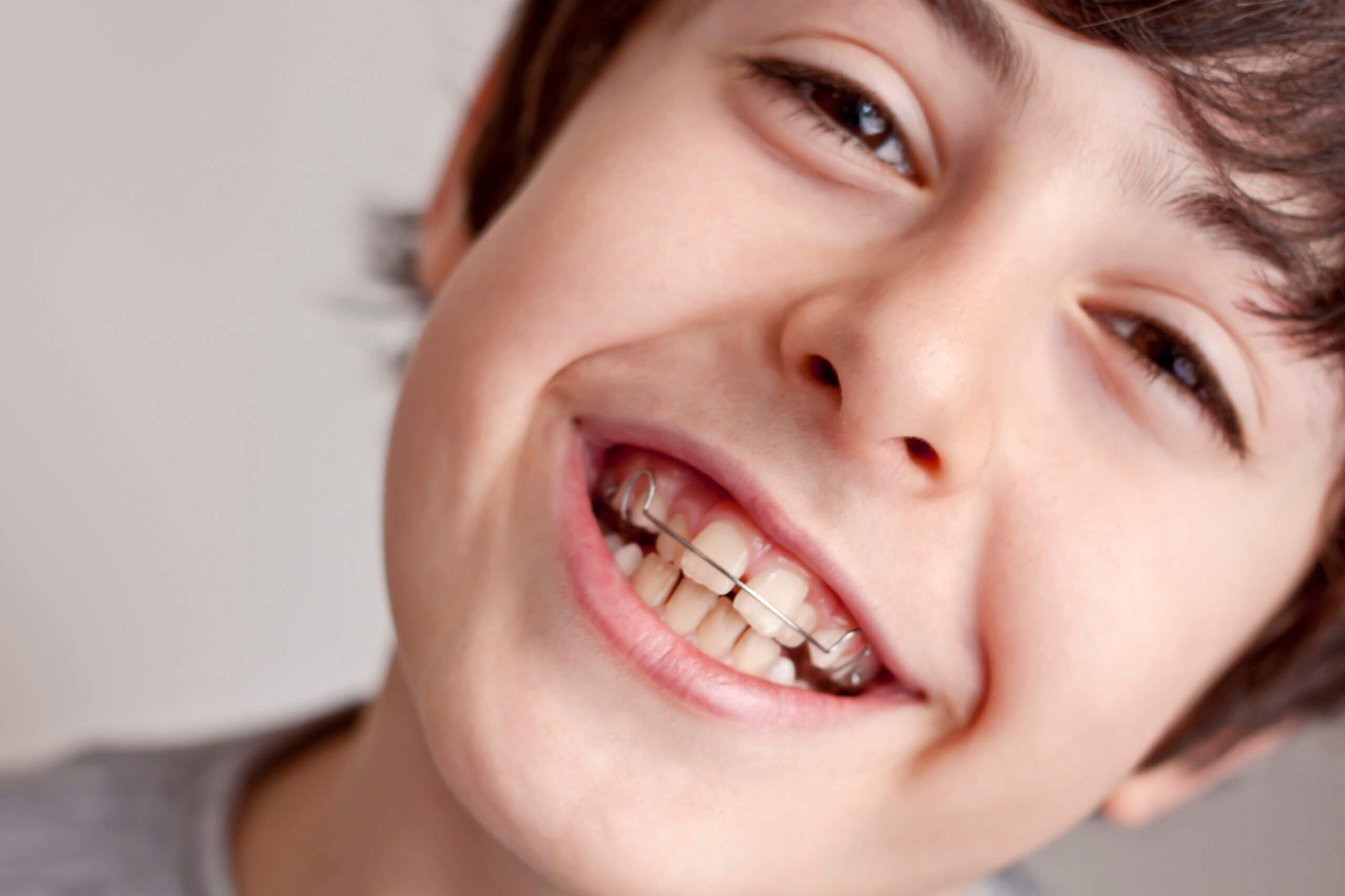 You are currently viewing יישור שיניים לילדים ולנוער – אפשרויות.